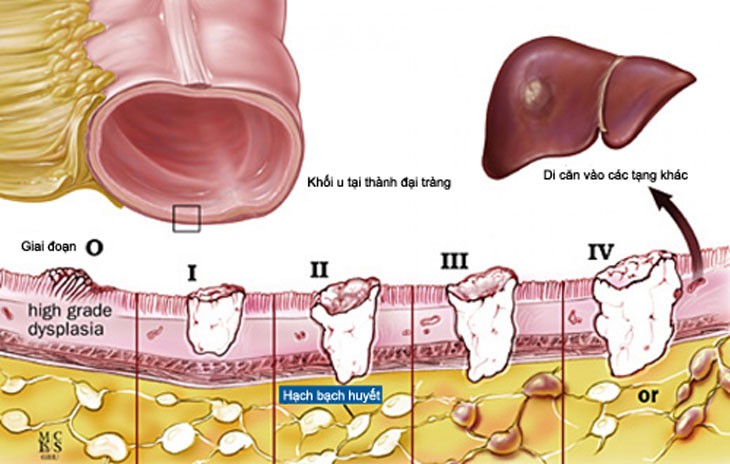 Điều trị ung thư đại tràng - Ảnh 1.