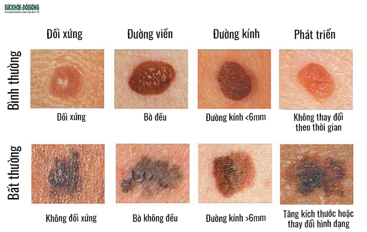Thận trọng với những dấu hiệu cảnh báo ung thư hắc tố da - Ảnh 2.