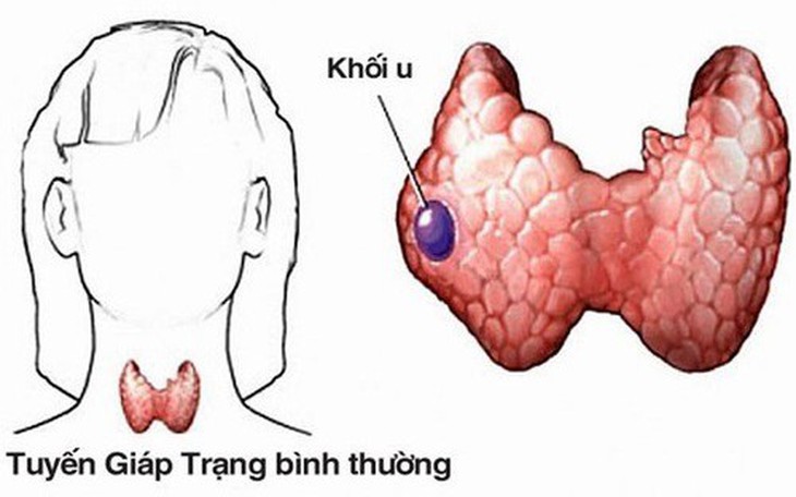 Chuyên gia lưu ý về chế độ ăn cho người bệnh ung thư tuyến giáp