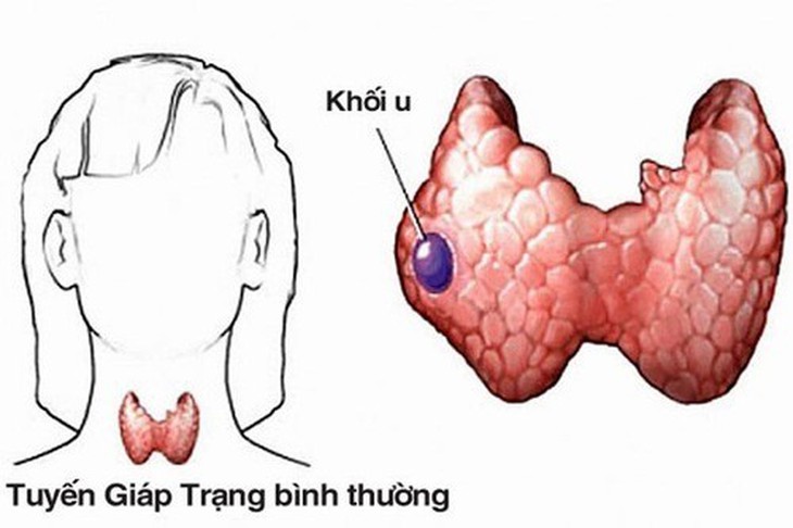 Ai có nguy cơ cao mắc ung thư tuyến giáp?- Ảnh 1. Ai có nguy cơ cao mắc ung thư tuyến giáp?- Ảnh 1.