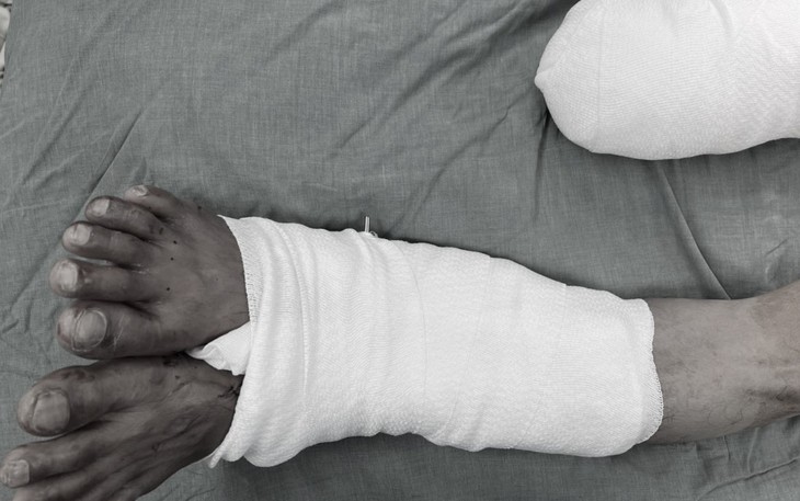 Việt Nam lần đầu tiên thực hiện "nuôi" chân bị đứt rời vào chân lành chờ nối chi