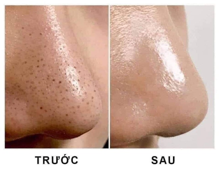Cách trị mụn đầu đen giúp da sáng mịn - Ảnh 1.