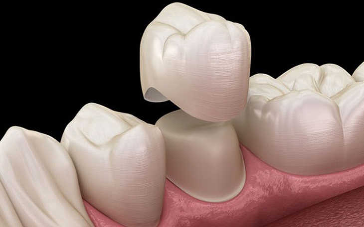 Bọc răng sứ, những cảnh báo đáng lưu ý