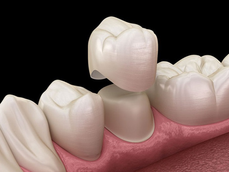 Bọc răng sứ: Những cảnh báo hết sức đáng lưu ý - Ảnh 1. Bọc răng sứ: Những cảnh báo hết sức đáng lưu ý - Ảnh 1.