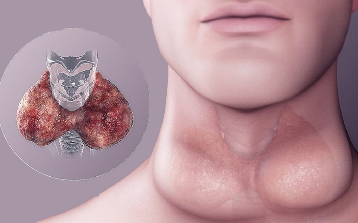 Suy giáp: Triệu chứng và những biến chứng không nên chủ quan