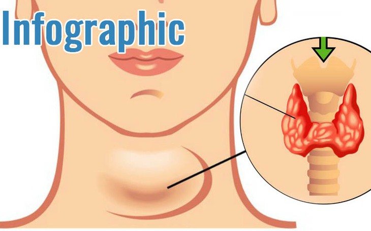 [Infographic] Suy giáp và cường giáp khác nhau như thế nào?