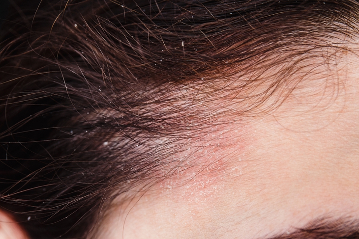 Suy giáp: Triệu chứng và những biến chứng cần biết - Ảnh 3.