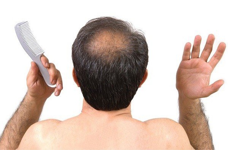 Không chỉ gây béo phì và đái tháo đường, đồ uống có đường còn gây rụng tóc ở nam giới - Ảnh 4.