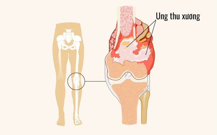 Ung thư xương: Bác sĩ cảnh báo những dấu hiệu cần lưu ý
