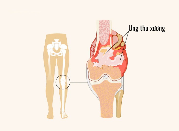 Ung thư xương: Bác sĩ cảnh báo những dấu hiệu cần lưu ý - Ảnh 1.