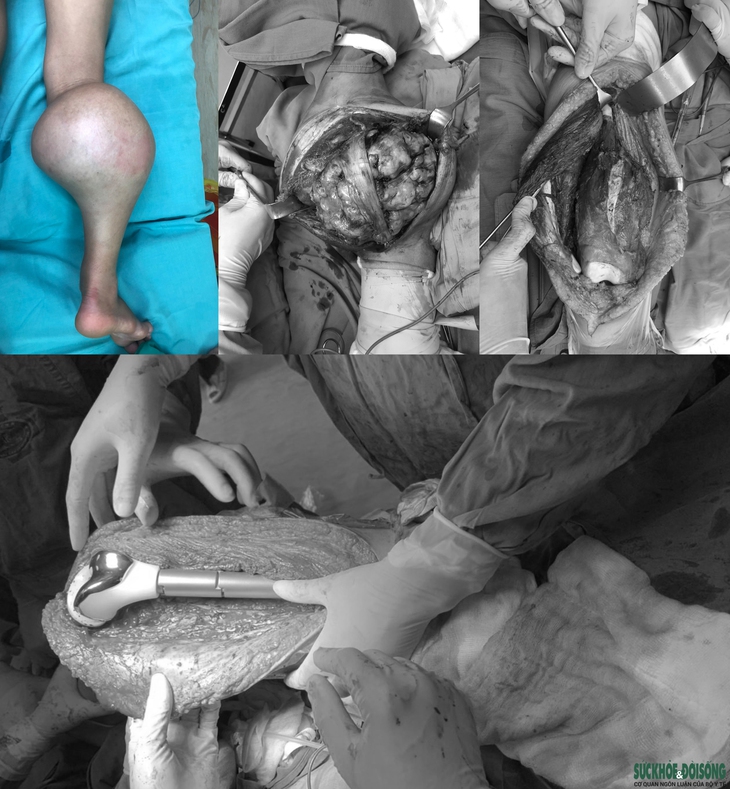 Ung thư xương: Nguyên nhân, phòng ngừa và phương pháp điều trị - Ảnh 2.