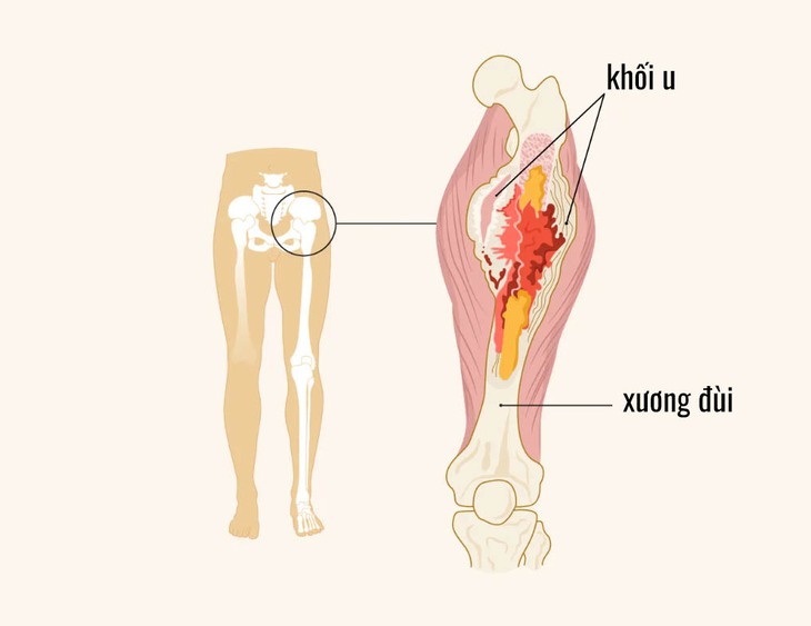 Ung thư xương: Bác sĩ cảnh báo những dấu hiệu cần lưu ý - Ảnh 2.