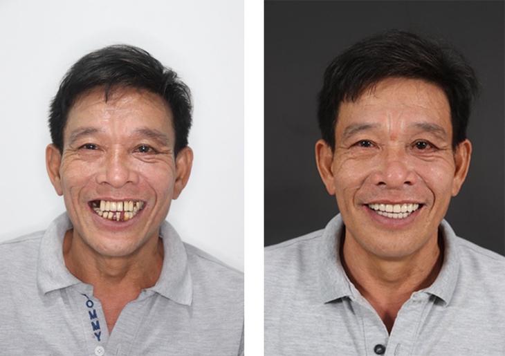 Nâng xoang cấy Implant và những điều cần lưu ý - Ảnh 1.
