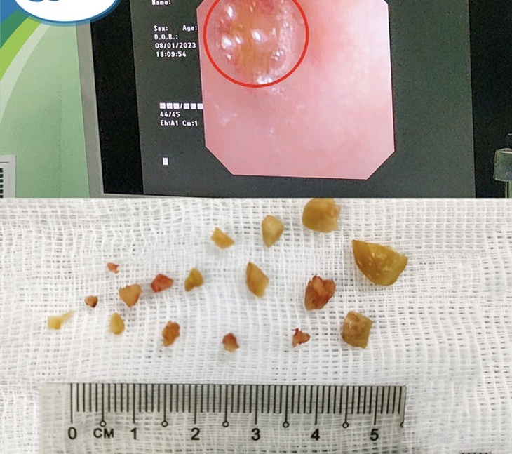 Người lớn bất cẩn, liên tiếp 3 trẻ hóc lạc, suy hô hấp nặng, nguy hiểm tính mạng - Ảnh 1.