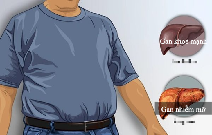 Bệnh gan nhiễm mỡ không do rượu là gì, ai dễ bị mắc? - Ảnh 1. Bệnh gan nhiễm mỡ không do rượu là gì, ai dễ bị mắc? - Ảnh 1.