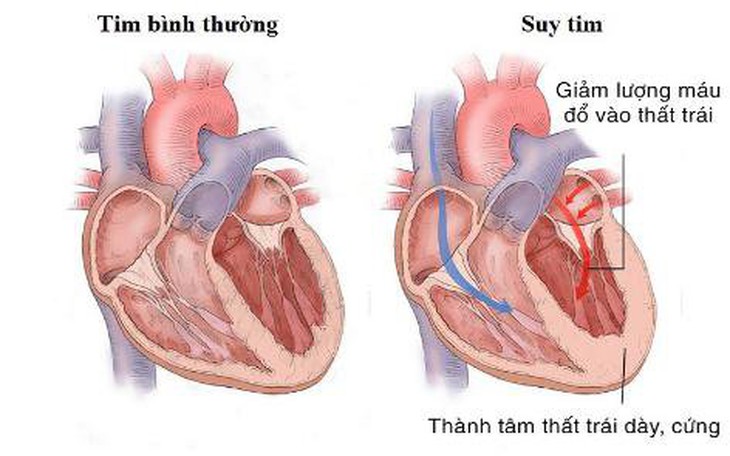 Lối sống lành mạnh giúp ngăn ngừa suy tim