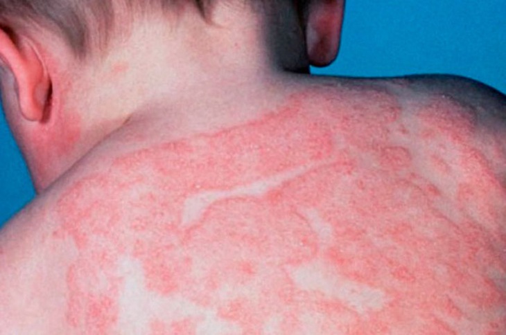 Trẻ sơ sinh có mắc vảy nến không? - Ảnh 2.