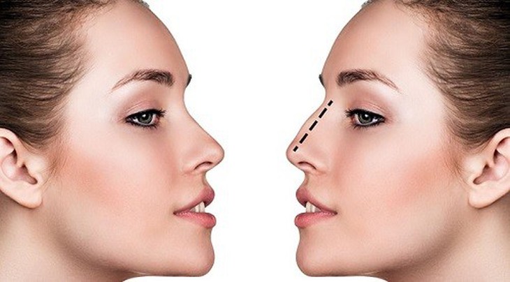 10 phương pháp làm đẹp không cần phẫu thuật và những điều cần biết - Ảnh 3. 10 phương pháp làm đẹp không cần phẫu thuật và những điều cần biết - Ảnh 3.