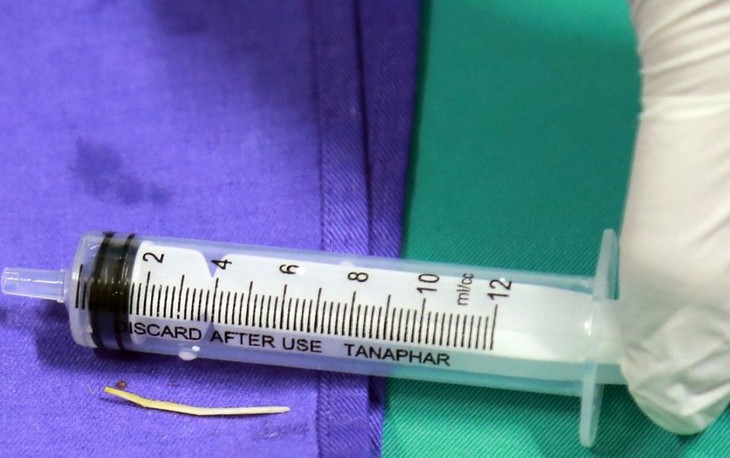 Gắp tăm tre dài 3 cm nằm trong tá tràng người phụ nữ từ 30 Tết - Ảnh 2.