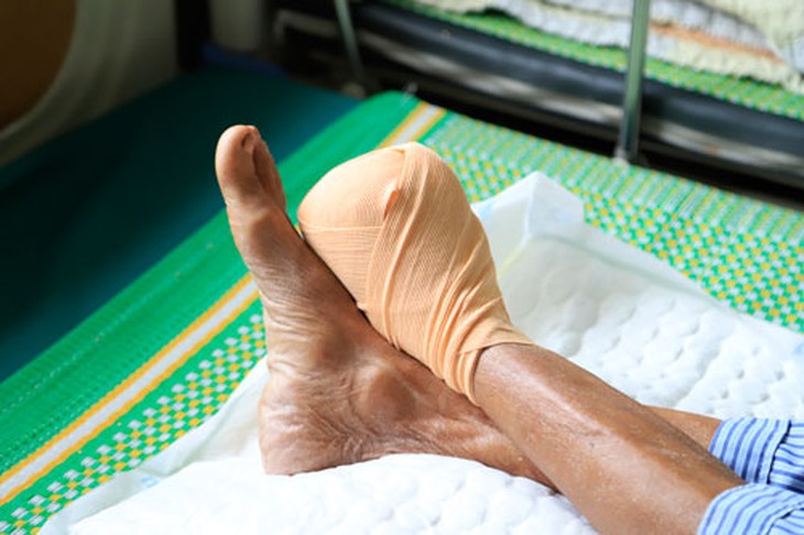 Cách xử trí biến chứng bàn chân đái tháo đường - Ảnh 1.