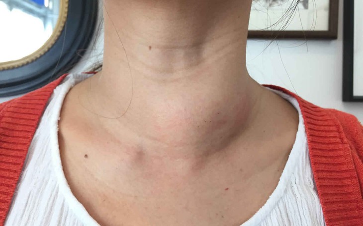 Bướu cổ: Triệu chứng, chẩn đoán và cách điều trị