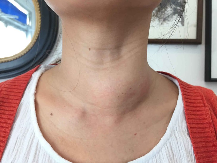 Bướu cổ có nguy hiểm không? Ai có khả năng mắc bướu cổ? - Ảnh 2. Bướu cổ có nguy hiểm không? Ai có khả năng mắc bướu cổ? - Ảnh 2.
