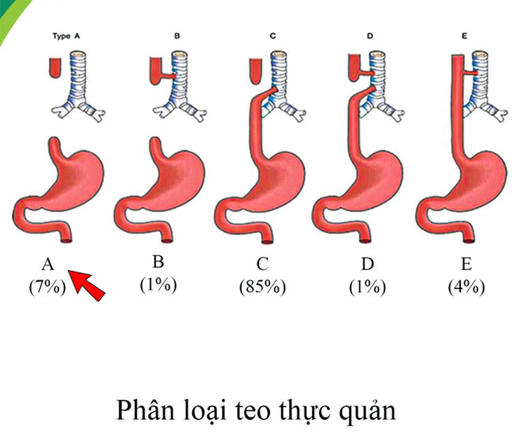 Phẫu thuật thành công "tạo hình thực quản bằng đại tràng" cho bé gái bị teo thực quản hiếm gặp - Ảnh 1.