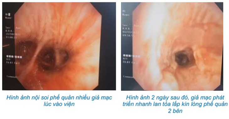Tự chữa cúm tưởng khỏi, nào ngờ chạy ECMO 37 ngày 'thập tử nhất sinh' - Ảnh 1. Tự chữa cúm tưởng khỏi, nào ngờ chạy ECMO 37 ngày 'thập tử nhất sinh' - Ảnh 1.