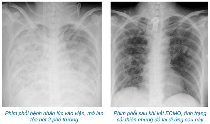 Tự chữa cúm tưởng khỏi, nào ngờ chạy ECMO 37 ngày 'thập tử nhất sinh' - Ảnh 4. Tự chữa cúm tưởng khỏi, nào ngờ chạy ECMO 37 ngày 'thập tử nhất sinh' - Ảnh 4.