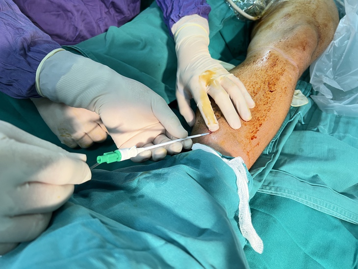 Can thiệp điều trị suy van tĩnh mạch hiển tái phát bằng Laser nội mạch cho người bệnh nước ngoài - Ảnh 4.