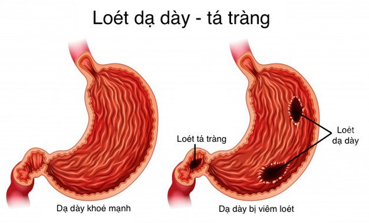Biện pháp điều trị loét dạ dày tá tràng - Ảnh 1.