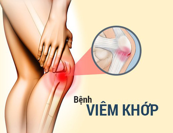 Người bệnh viêm khớp nên uống gì để giảm cơn đau khi trời lạnh? - Ảnh 2. Người bệnh viêm khớp nên uống gì để giảm cơn đau khi trời lạnh? - Ảnh 2.