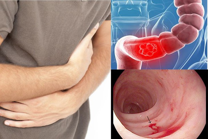 Phát hiện mắc ung thư sau 3 tháng rối loạn tiêu hóa- Ảnh 1.
