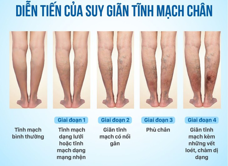 Ai có nguy cơ mắc bệnh suy giãn tĩnh mạch chân? - Ảnh 2.