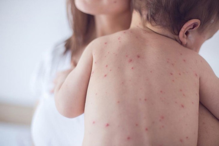 Dự phòng bệnh sởi cho trẻ trong mùa đông xuân - Ảnh 2.