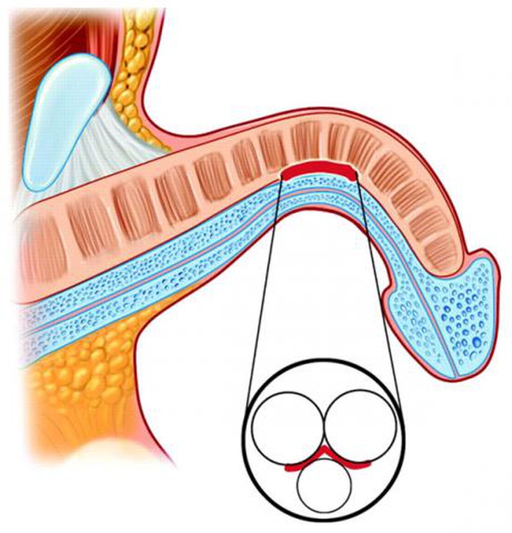 Nhiều nam giới bị cong dương vật nhưng mức độ cong nào cần đi khám chuyên khoa ngay? - Ảnh 4.