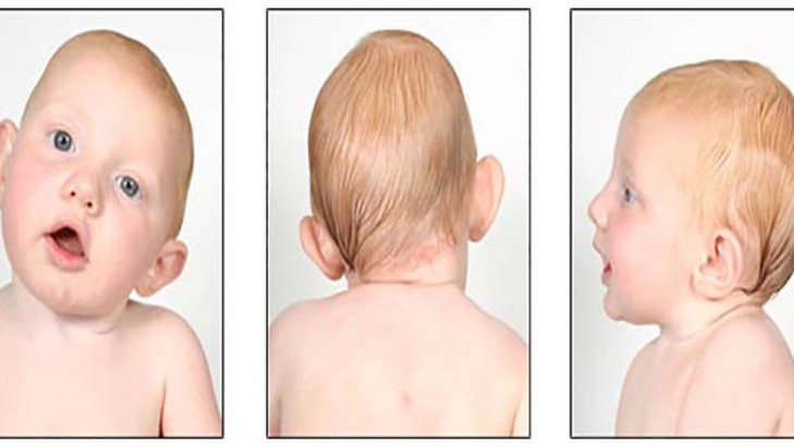 Vẹo cổ ở trẻ cần phát hiện sớm - Ảnh 2.