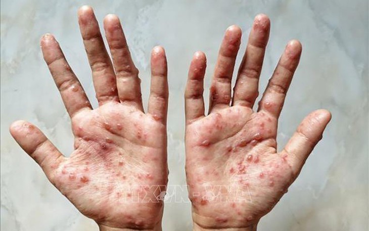 Phát hiện thêm 1 trường hợp mắc đậu mùa khỉ ở TPHCM