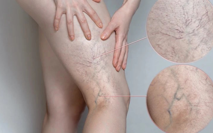 Suy giãn tĩnh mạch có thể gây ra hoại tử một số bộ phận cơ thể