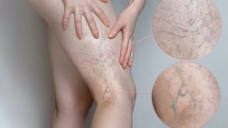 Suy giãn tĩnh mạch có thể gây ra hoại tử một số bộ phận cơ thể - Ảnh 1.