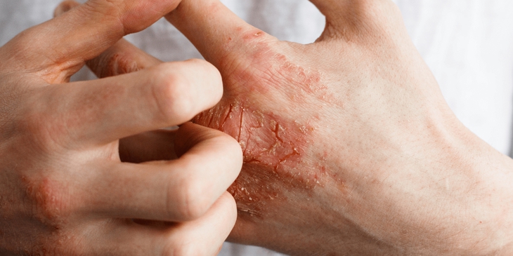 Viêm da cơ địa dùng thuốc gì để giảm ngứa? - Ảnh 2.
