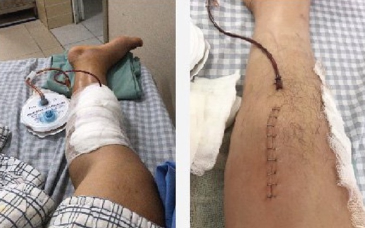 Tự ý dùng thuốc Đông - Tây y kết hợp, bệnh nhân trẻ tuổi suýt hoại tử chân