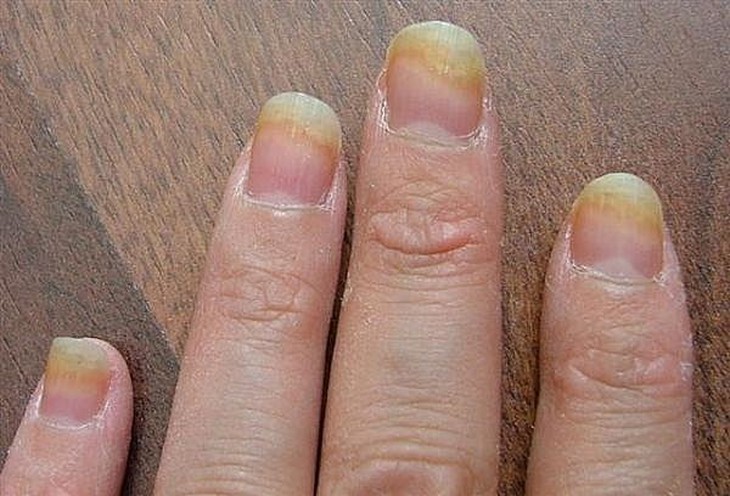 Nấm móng tay/móng chân do sơn móng, xử trí thế nào - Ảnh 1.