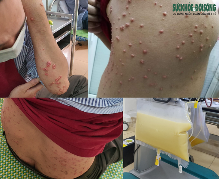 Rối loạn mỡ máu có nguy hiểm không? - Ảnh 2.
