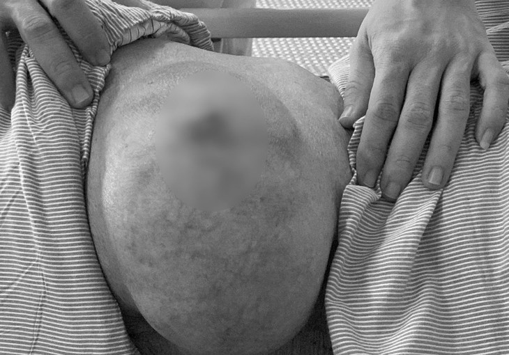 Khối u 30 năm 'đeo bám' cụ ông 97 tuổi - Ảnh 1.