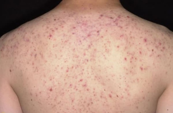 Cách khắc phục mụn trứng cá ở lưng - Ảnh 1. Cách khắc phục mụn trứng cá ở lưng - Ảnh 1.