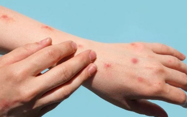 TPHCM ghi nhận ca đậu mùa khỉ thứ 19