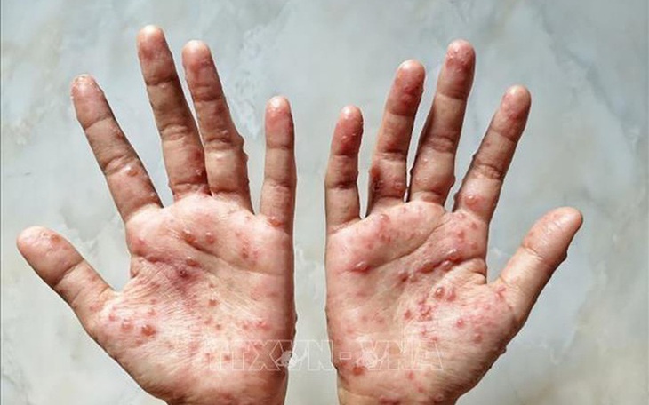 TPHCM ghi nhận ca đậu mùa khỉ thứ 19 - Ảnh 1. TPHCM ghi nhận ca đậu mùa khỉ thứ 19 - Ảnh 1.