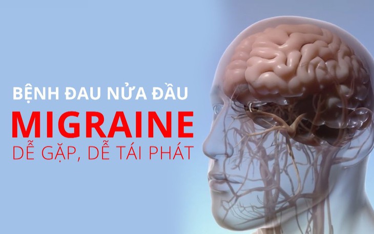 Bệnh đau nửa đầu điều trị như thế nào?