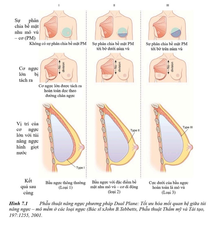 Nâng ngực Dual Plane - kỹ thuật thường quy trong nâng ngực Harmonic - Ảnh 2.